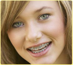 stock photo of a teen girl with braces